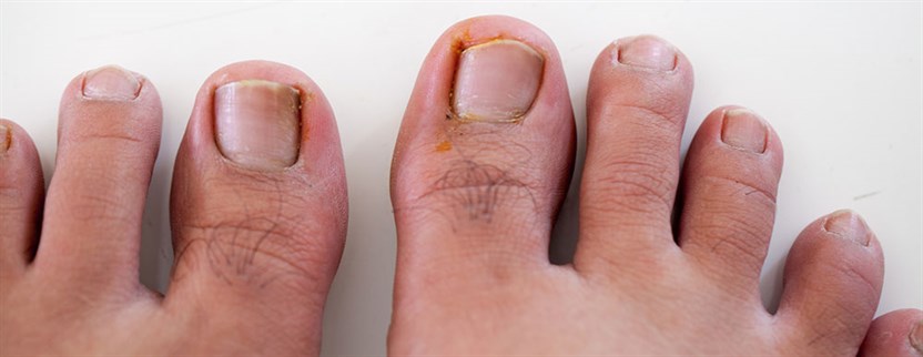 Ingrown Toe Nail  Edmonton Foot Clinic