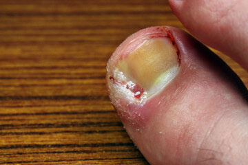 Ingrown toenails, Dubai | Al Das Medical Clinic