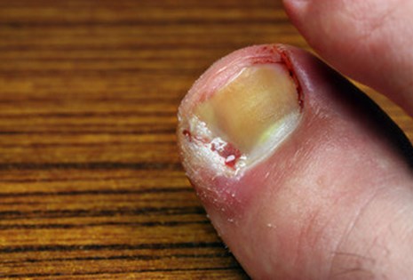Ingrown Toenail Treatment Ingrown Toenail Treatment