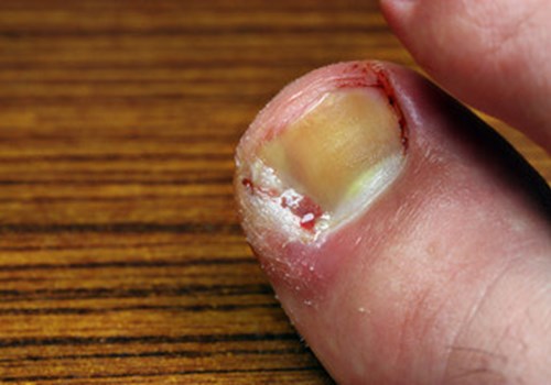 Ingrown toenail placeholder.jpg Ingrown toenail placeholder.jpg