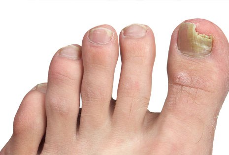 Nail Fungus Treatment