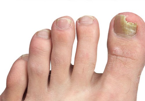 nail-fungus-treatment.jpg (1) nail-fungus-treatment.jpg (1)