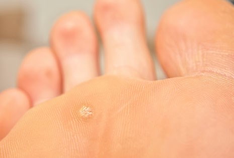 Cryosurgery for Wart Treatments