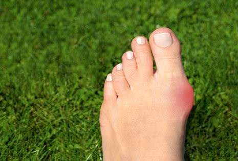 Bunion Treatment Bunion Treatment