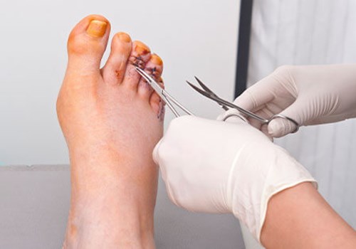 Hammer Toes - Custom Foot Clinic & Orthotic Centre