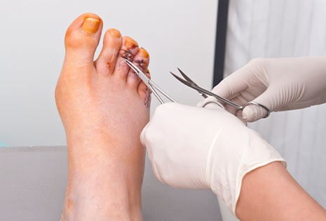 Foot Surgery Procedures Foot Surgery Procedures